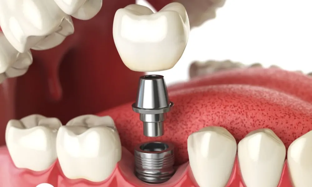 cap dental implants