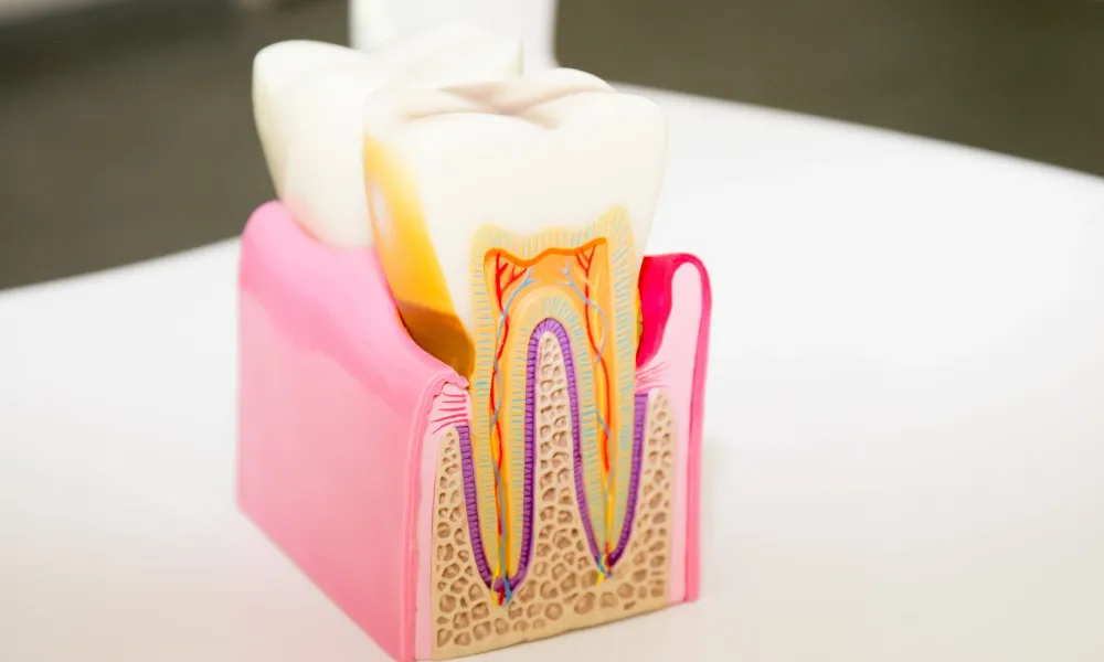 cap dental root canal