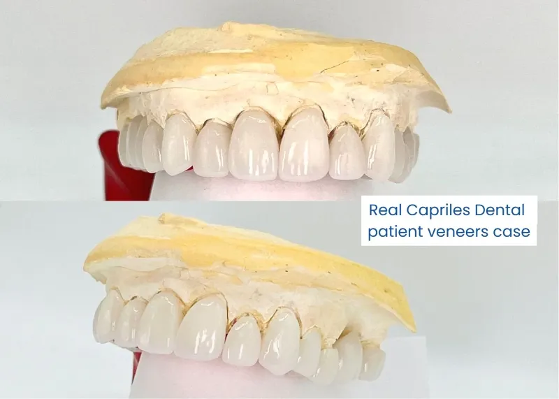 cap dental veneers