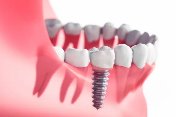dental implants (1)
