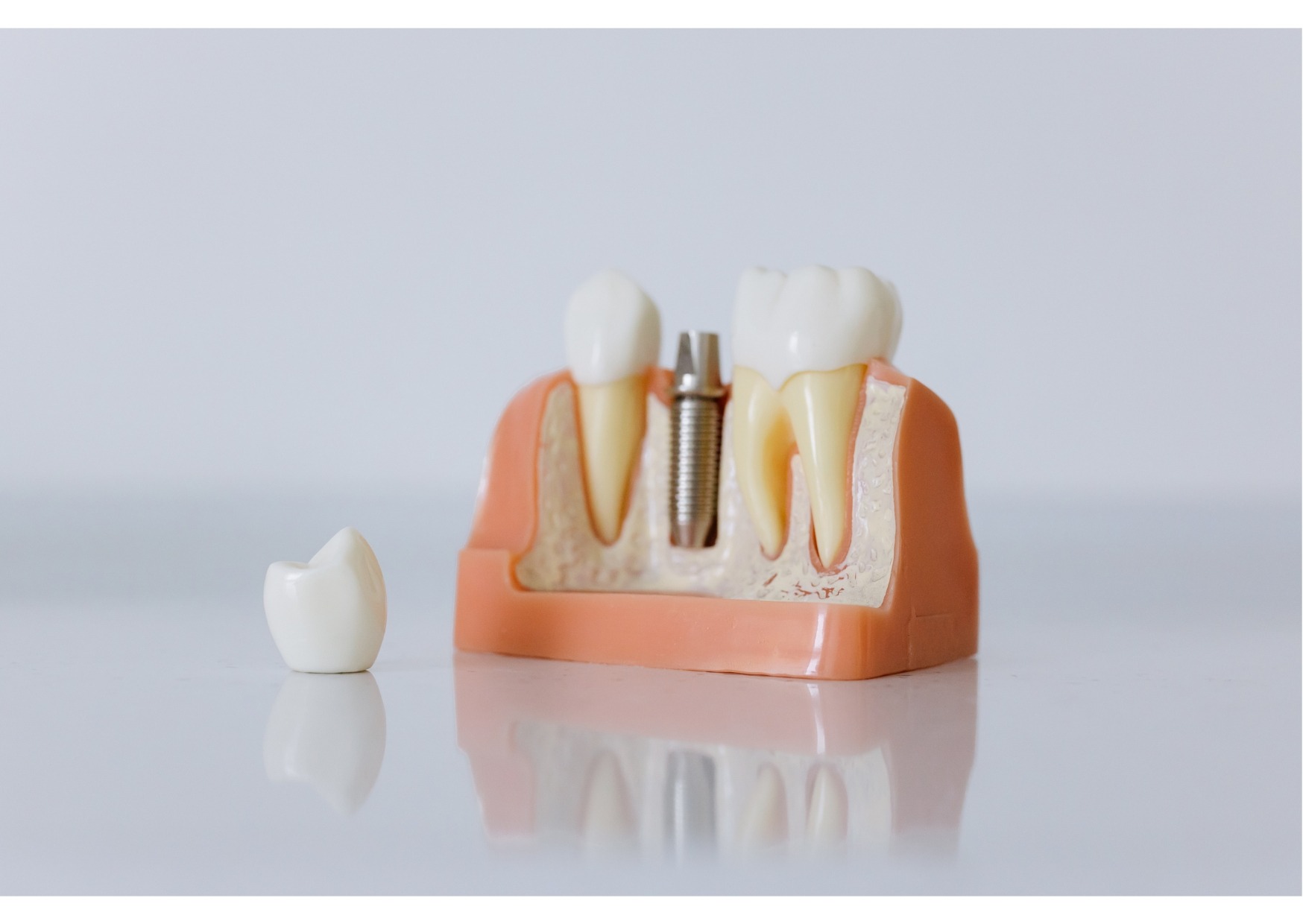 Close-up dental implant model showing titanium post, crown, and surrounding bone structure.
