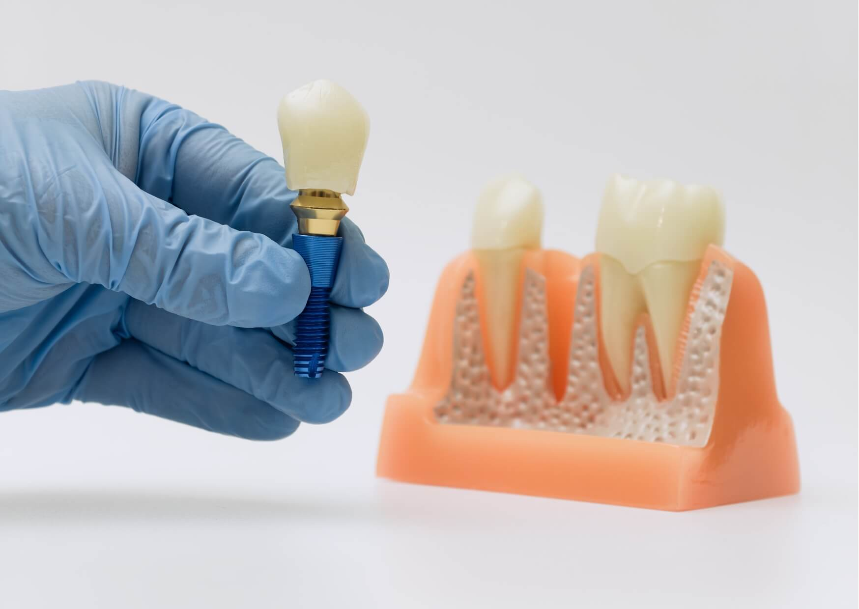 Dental implant model displayed beside a tooth model, illustrating the components involved in dental implant removal and replacement procedures.