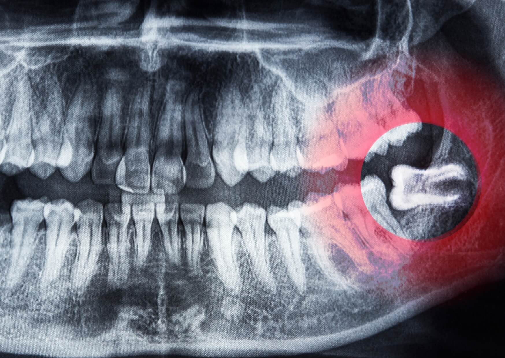 Panoramic dental X-ray showing an impacted wisdom tooth developing beneath the gums, illustrating what a wisdom tooth looks like coming in.
