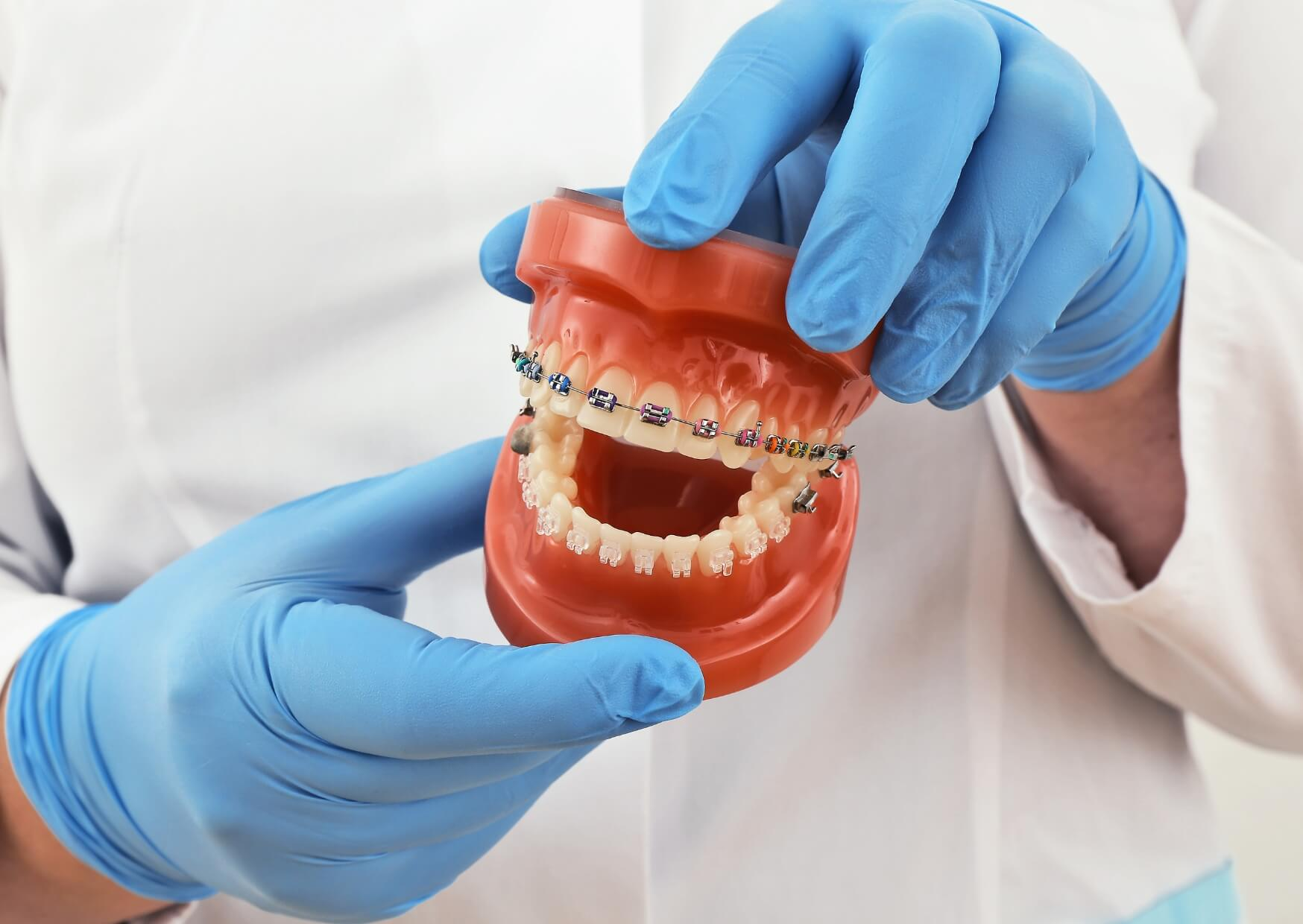 Dental model with braces used to explain orthodontic treatment options, costs, and insurance coverage.