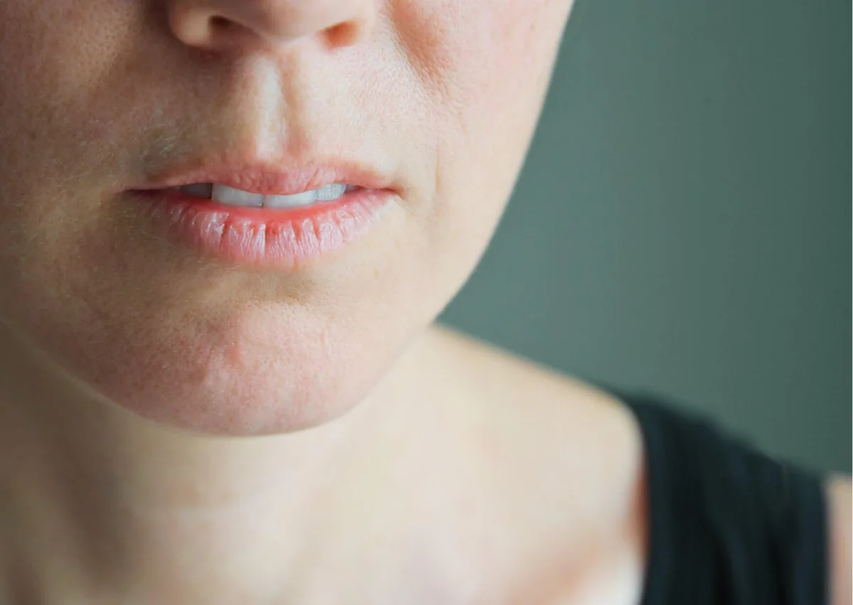 Close-up of a person’s dry lips and mouth showing a common symptom of dry mouth.