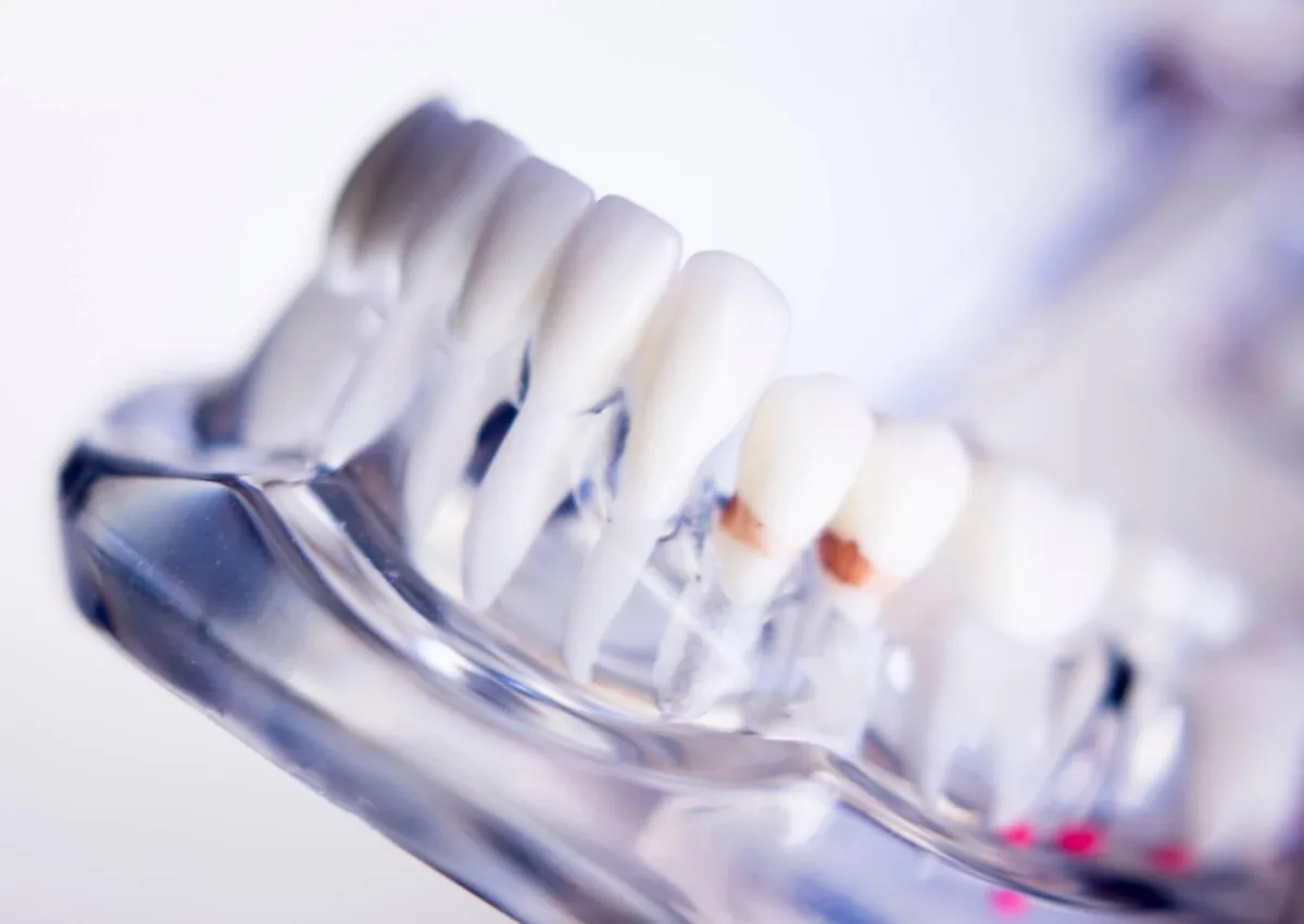 Dental model showing plaque buildup between teeth and along the gumline.